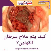 كيف يتم علاج سرطان القولون؟ والقيادة السياسية حريصة على توطين صناعة اللقاحات في مصر