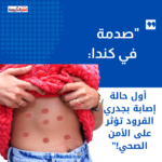 "صدمة في كندا: أول حالة إصابة بجدري القرود تؤثر على الأمن الصحي!"
