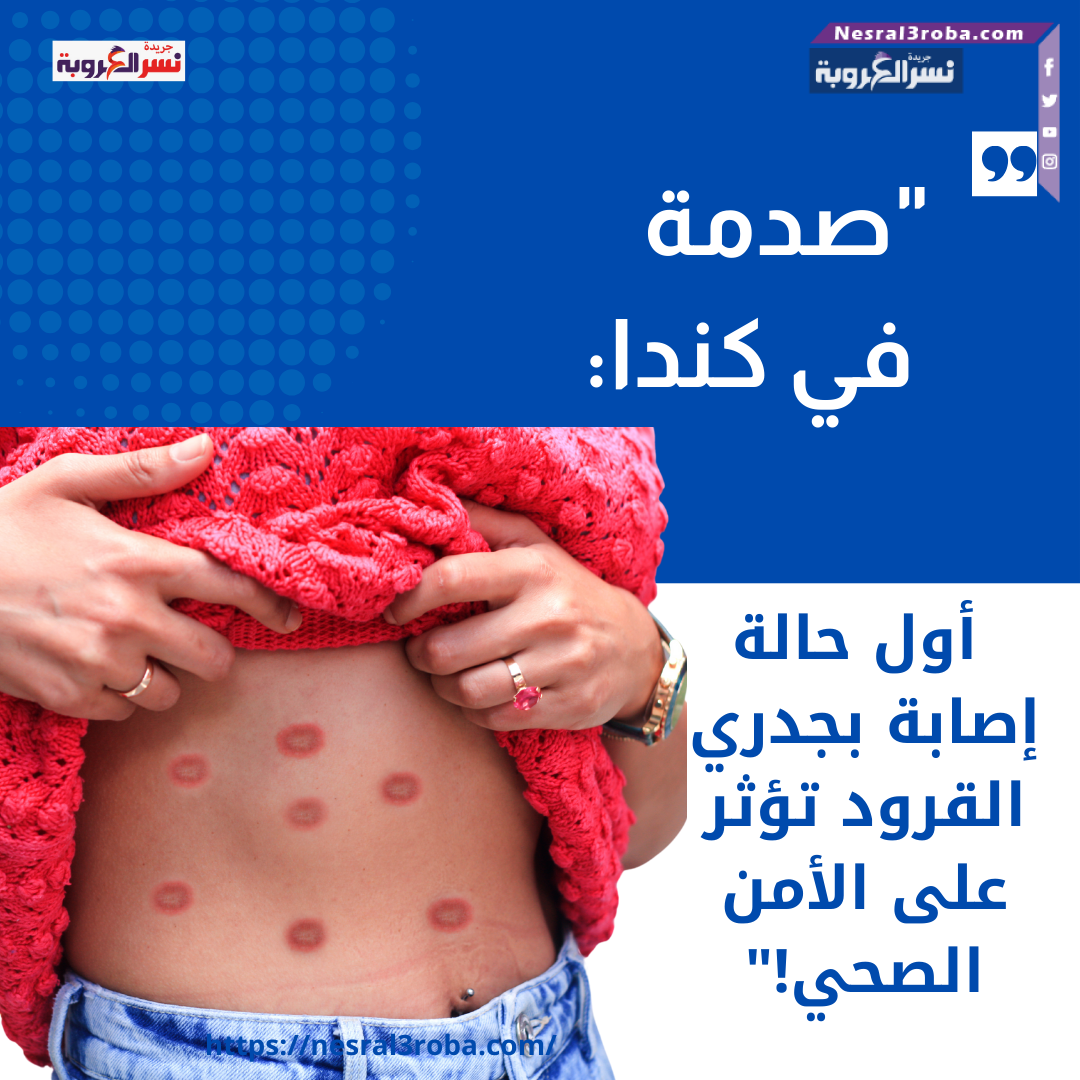 "صدمة في كندا: أول حالة إصابة بجدري القرود تؤثر على الأمن الصحي!"