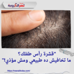 قشرة رأس طفلك؟ ما تخافيش ده طبيعي ومش مؤذي!"
