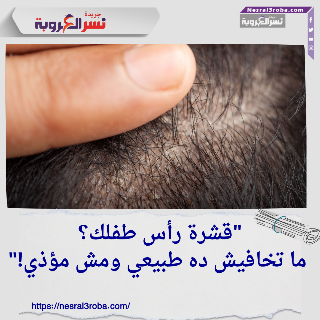 قشرة رأس طفلك؟ ما تخافيش ده طبيعي ومش مؤذي!"