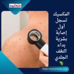 المكسيك تسجل أول إصابة بشرية بداء النغف الجلدي 🦠