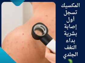 المكسيك تسجل أول إصابة بشرية بداء النغف الجلدي 🦠