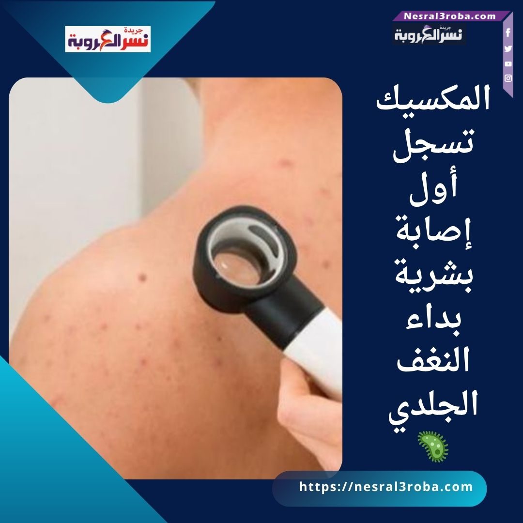 المكسيك تسجل أول إصابة بشرية بداء النغف الجلدي 🦠