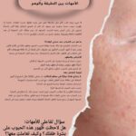 حب الشباب عند حديثي الولادة.. قلق الأمهات بين الحقيقة والوهم