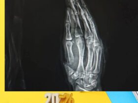 نجاح مزهل في مستشفي سوهاج الجامعى .. إنقاذ شاب بعد بتر إصبع الإبهام