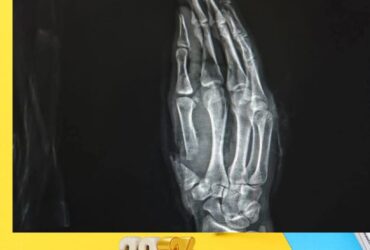 نجاح مزهل في مستشفي سوهاج الجامعى .. إنقاذ شاب بعد بتر إصبع الإبهام